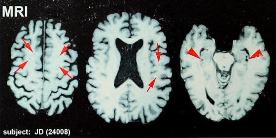 Brain scans of NFL hall of famer Joe DeLamielleure, who was diagnosed with CTE.